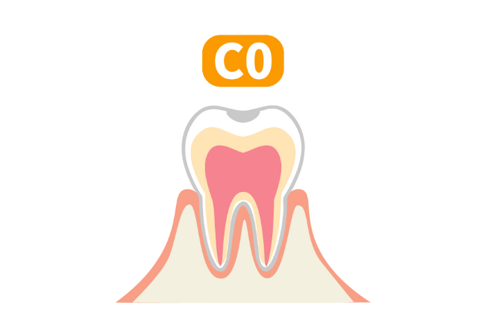 C0（初期虫歯）