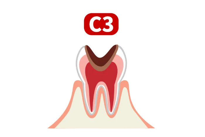 C3（神経への進行）