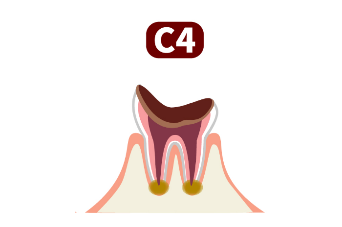 C4（歯の根まで進行）