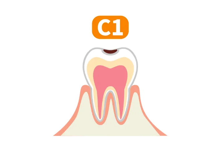 C1（エナメル質の溶解）